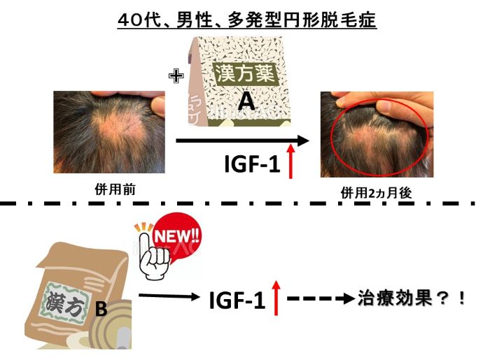 円形脱毛症　病院